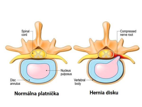 plotynka normalni vs. hernie